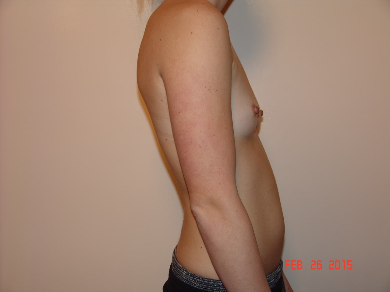 Before Image: Breast Augmentation - right-side