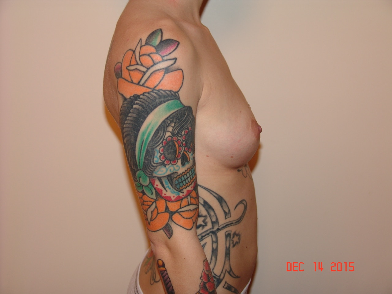 Before Image: Breast Augmentation - right-side
