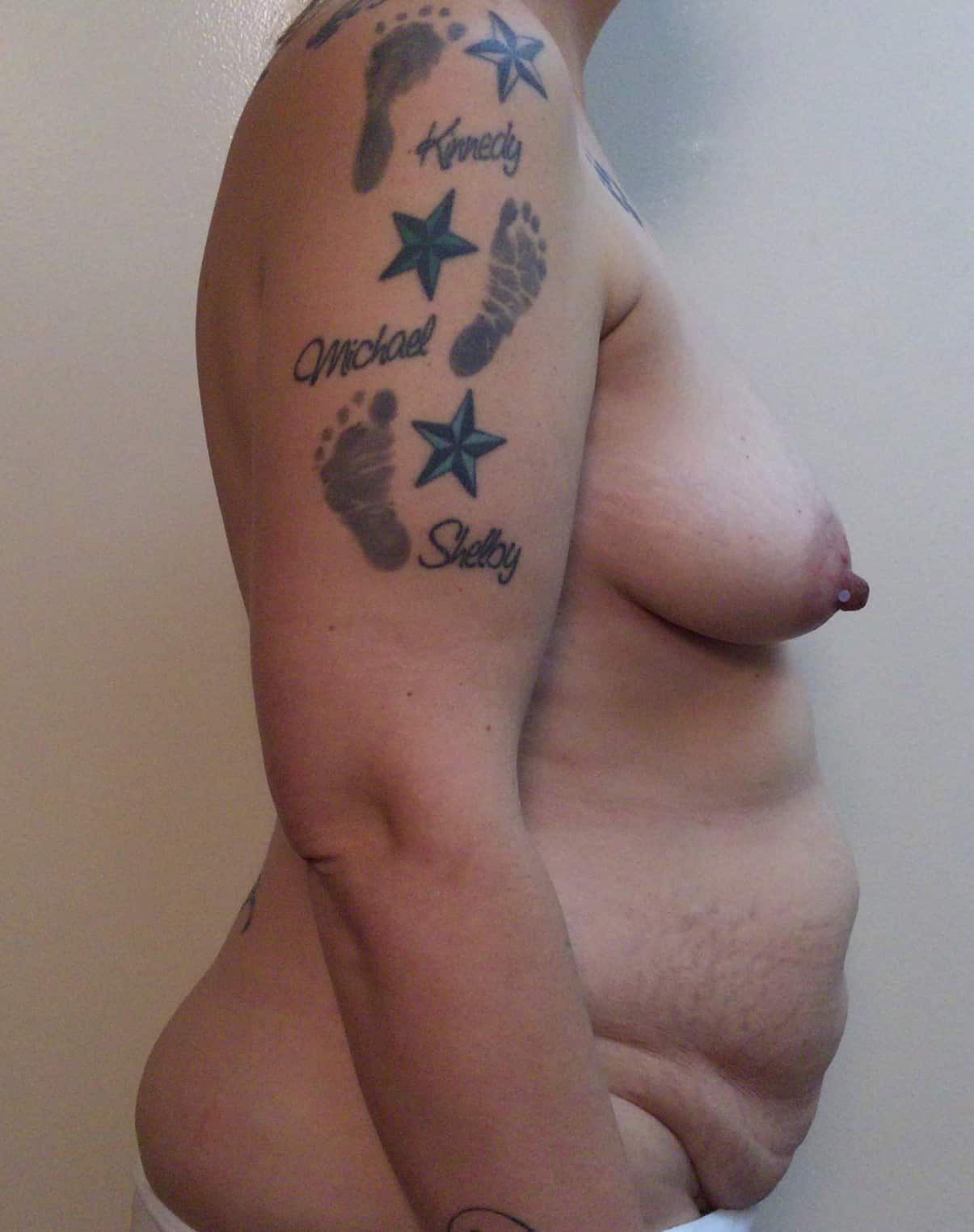 Before Image: Mommy Makeover - right-side
