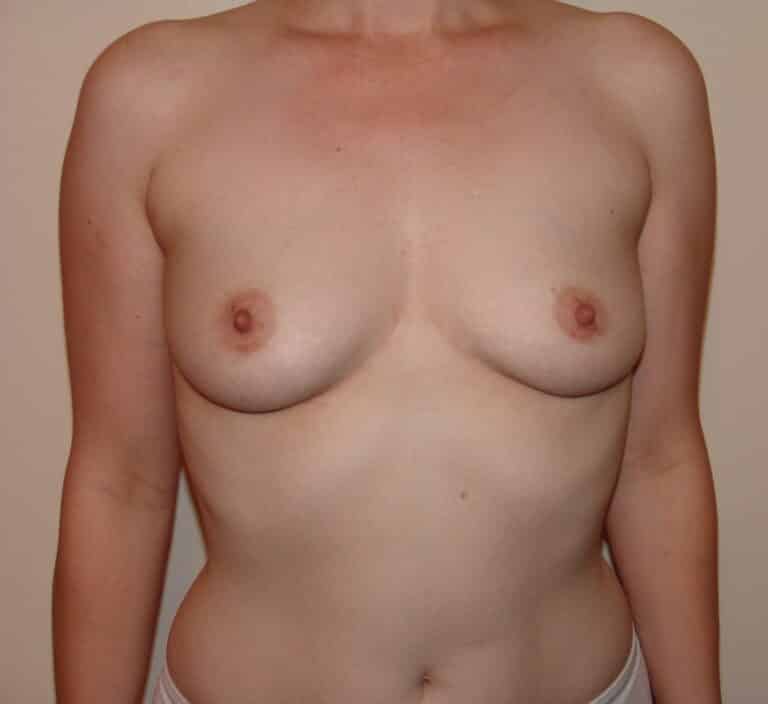 Before Image: Breast Augmentation - front