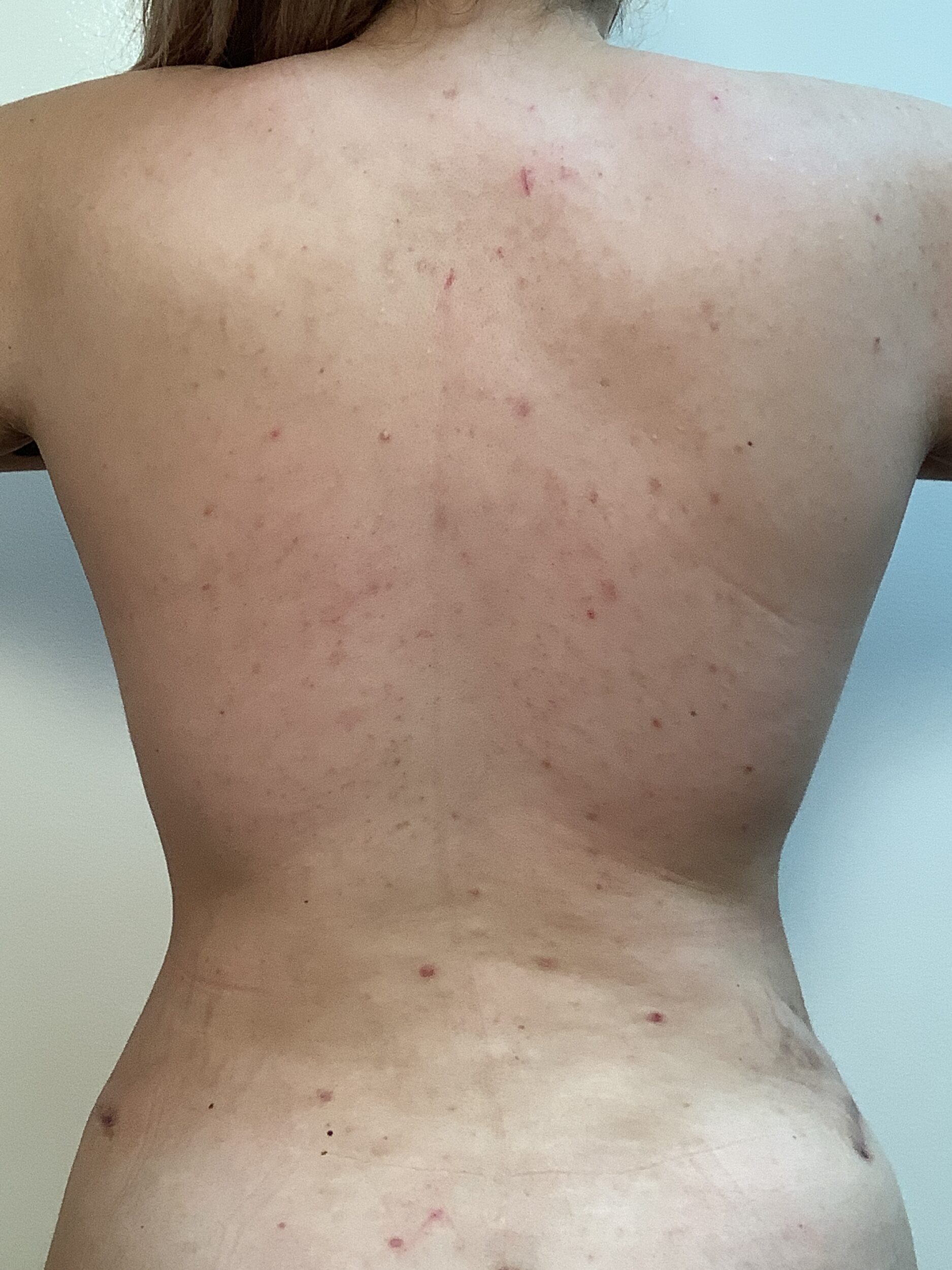 After Image: Liposuction - back