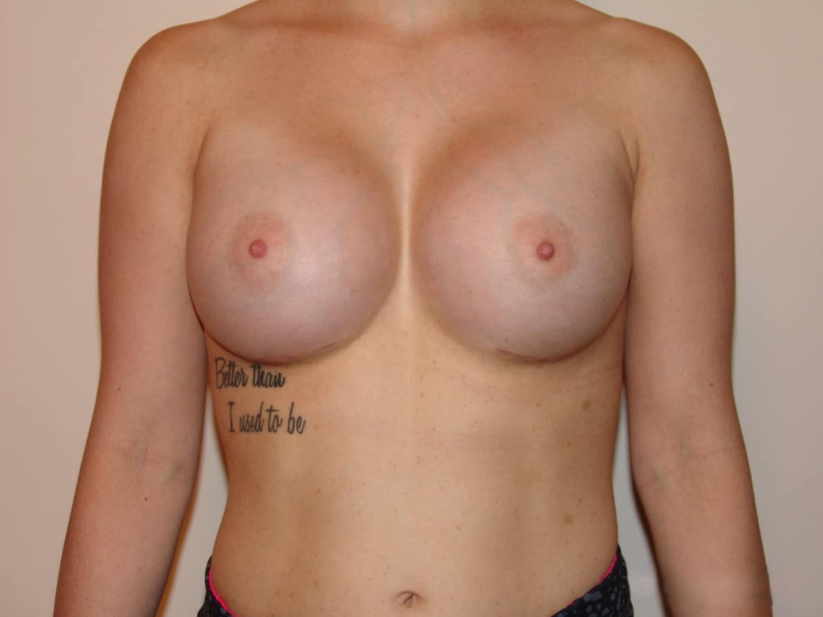 After Image: Breast Augmentation - front