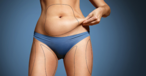 How Much Does Liposuction Cost Take the First Step Toward a Stronger & Flatter Midsection