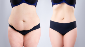 Tummy Tuck Surgery Before the Procedure: Your Preparation Phase